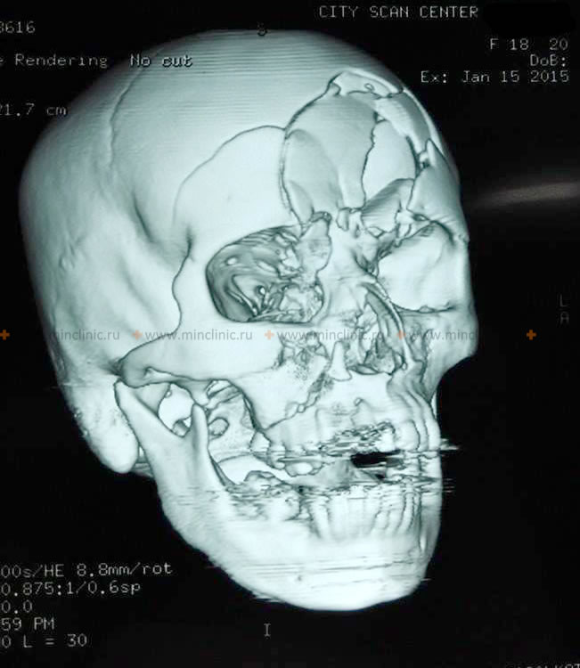 Skull CT scan revealed an impressed fracture of the frontal bone in the region of the frontal sinus with damage to the left orbit roof.